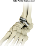 Total Ankle Joint Replacement