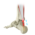 Achilles Tendon Repair