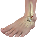 Complex Fractures of the Foot and Ankle