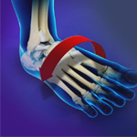 Ankle Instability Surgery