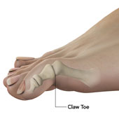 Foot and Toe Deformities