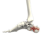 Foot Fracture