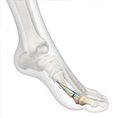 Minimally Invasive Bunion Surgery