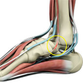 Tendon and Ligament Injuries